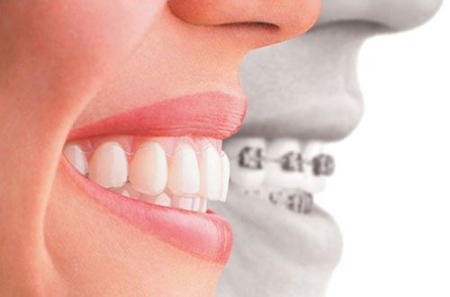 Niềng Răng Thẩm Mỹ Tại Nha Khoa Thái Dương