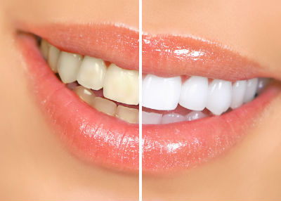 Giải Pháp Tẩy Trắng Răng Phù Hợp Cho Mọi Khách Hàng