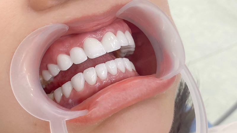 Sự Thật Về Dịch Vụ Răng Sứ Nha Khoa Thái Dương: Có Đáng Để Bạn Lựa Chọn?