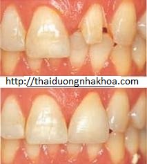 Bọc Răng Sứ Như Thế nào?