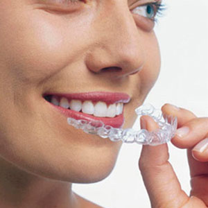 Quy trình niềng răng trong suốt  và những lưu ý quan trọng