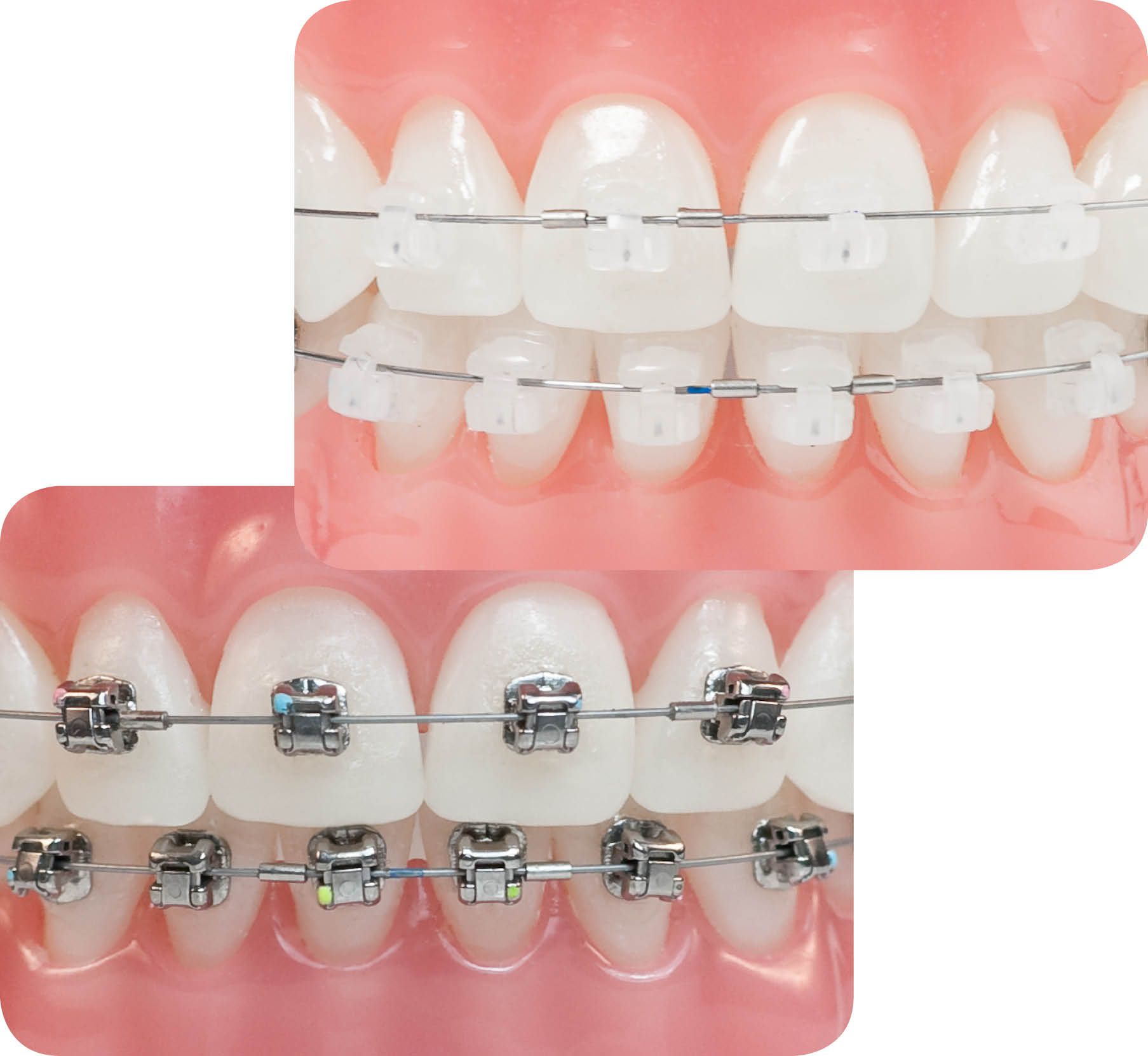 Dịch Vụ Niềng Răng Tại Nha Khoa Thái Dương