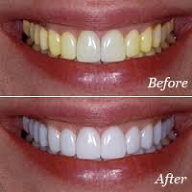 Tạm Biệt Răng Ố Vàng Với Dịch Vụ Tẩy Trắng Răng Thái Dương