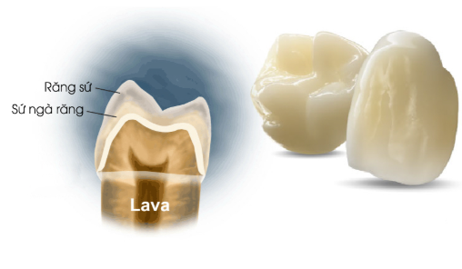 So Sánh Sứ Cao Cấp Nha Khoa Thái Dương: Lava, Cercon HT, DDBIO, Orodent - Loại Nào Tốt Nhất Cho Bạn? [Ưu - Nhược Điểm, Giá Cả, Ứng Dụng]