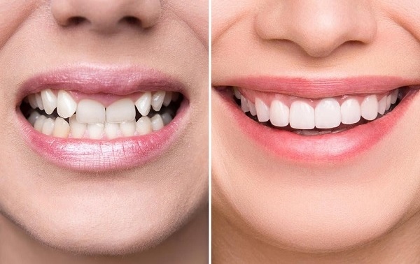 Răng Sứ Nào Phù Hợp Với Bạn? Tìm Hiểu Dựa Trên Tình Trạng Răng & Ngân Sách