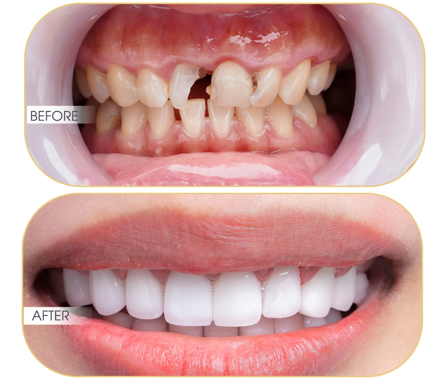 Dịch Vụ Làm Răng Sứ Thẩm Mỹ Chuyên Nghiệp Tại Nha Khoa Thái Dương: Nụ Cười Hoàn Hảo Trong Tầm Tay