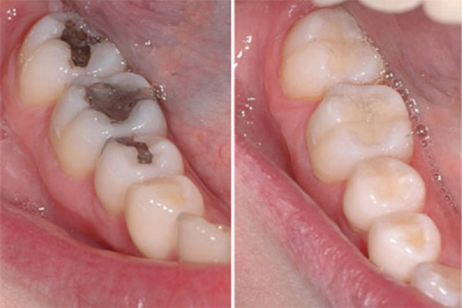 Trám Răng Có Đau Không? Câu Trả Lời Từ Bác Sĩ Nha Khoa Thái Dương