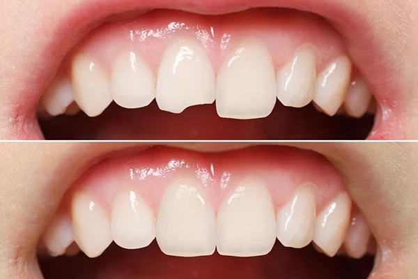 Dịch Vụ Trám Răng Thẩm Mỹ Uy Tín Tại Nha Khoa Thái Dương