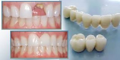 Làm Răng Sứ Uy Tín,Răng Sứ Thẩm Mỹ,Răng Sứ Đẹp ở TPHCM