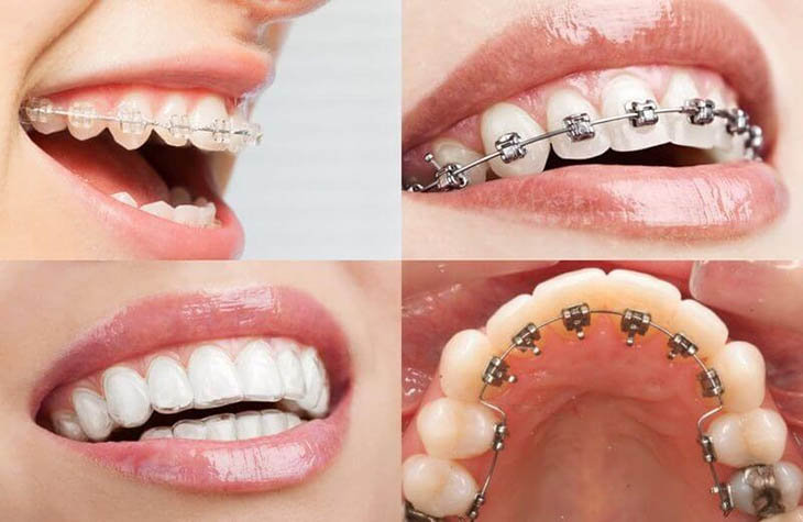Niềng Răng Nha Khoa Thái Dương: Bí Quyết Nụ Cười Hoàn Hảo, Ưu Điểm Vượt Trội