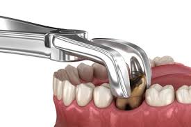 Đánh Giá Chi Tiết Dịch Vụ Nhổ Răng Tại Nha Khoa Thái Dương: Có Gì Khác Biệt?