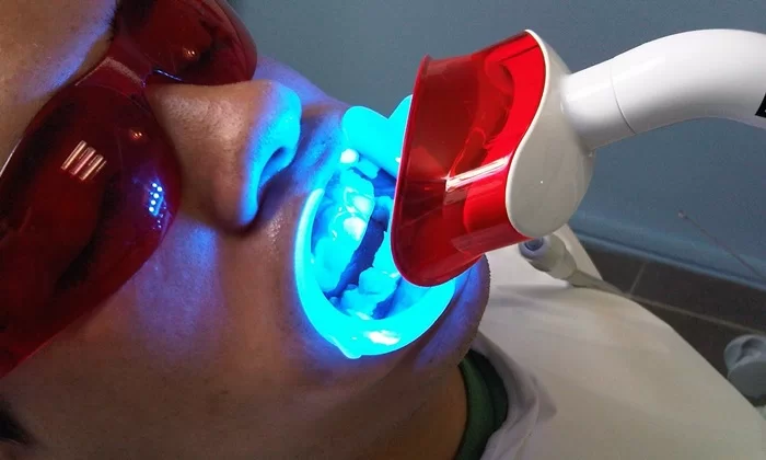 Tẩy Trắng Răng Plasma Có Tốt Không? Ưu Nhược Điểm & Lưu Ý Quan Trọng