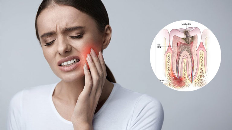 Ê Buốt Răng: Bí Quyết Chăm Sóc Để Hết Khó Chịu Ngay Tại Nhà