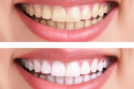 Tẩy Trắng Răng Định Kỳ: Quy Trình, Lợi Ích & Chi Phí Bạn Cần Biết