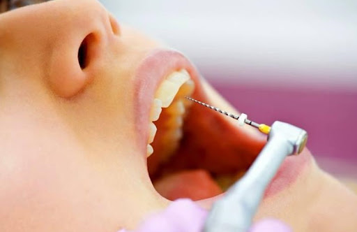 ĐIỀU TRỊ TUỶ RĂNG